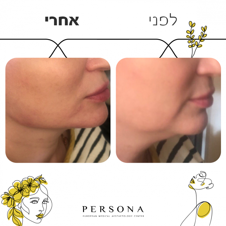 עיצוב קו לסת - פרסונה