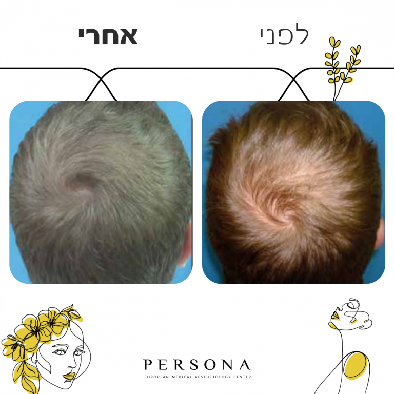 לפני אחרי PRP1