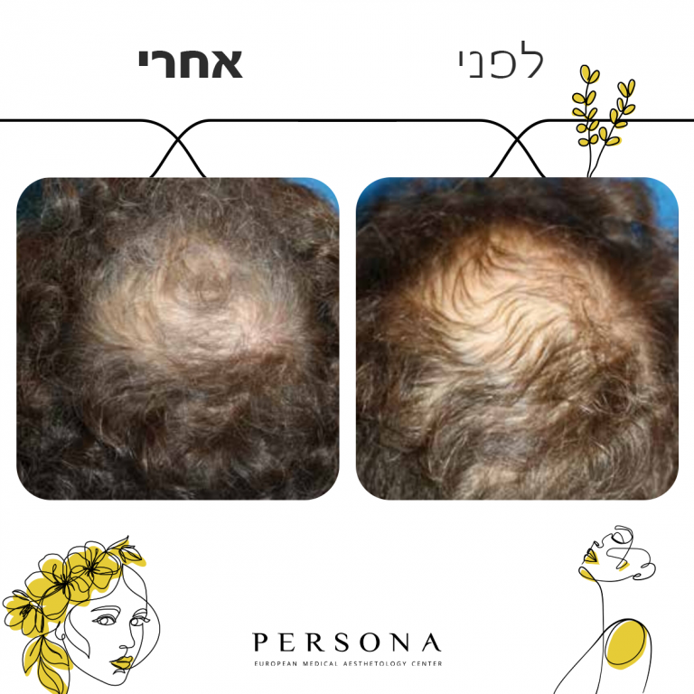 לפני אחרי PRP2