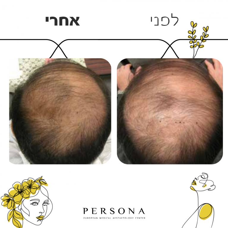 לפני אחרי PRP3