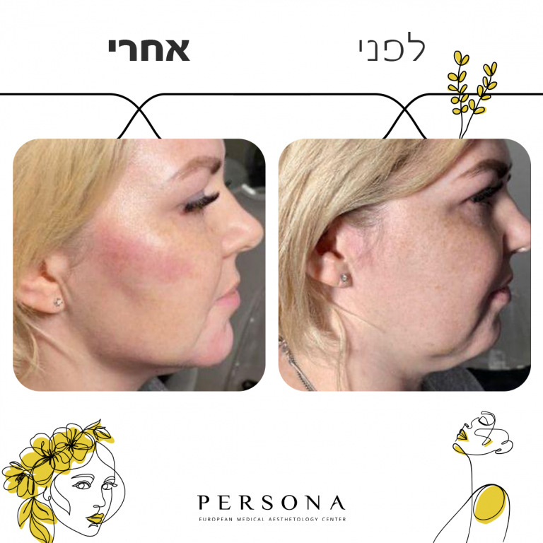 לפני אחרי עצמות לחיים1