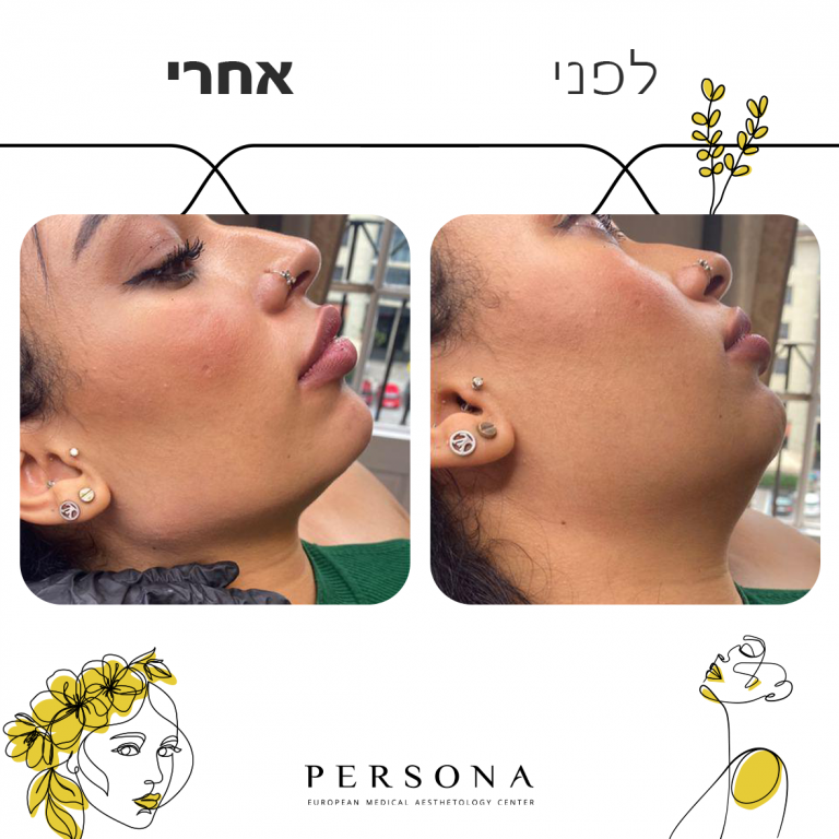 לפני אחרי עצמות לחיים2