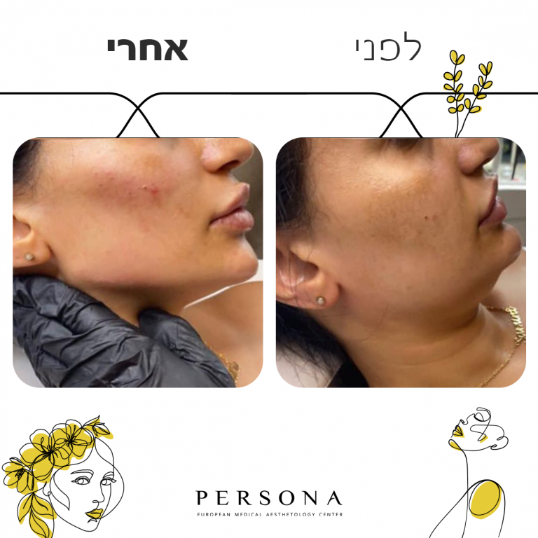 לפני אחרי עצמות לחיים3