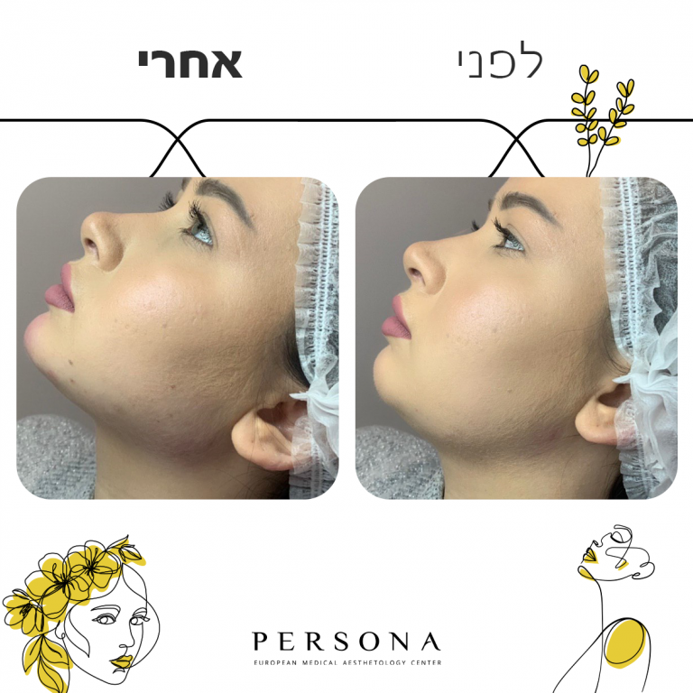 לפני אחרי עצמות לחיים4