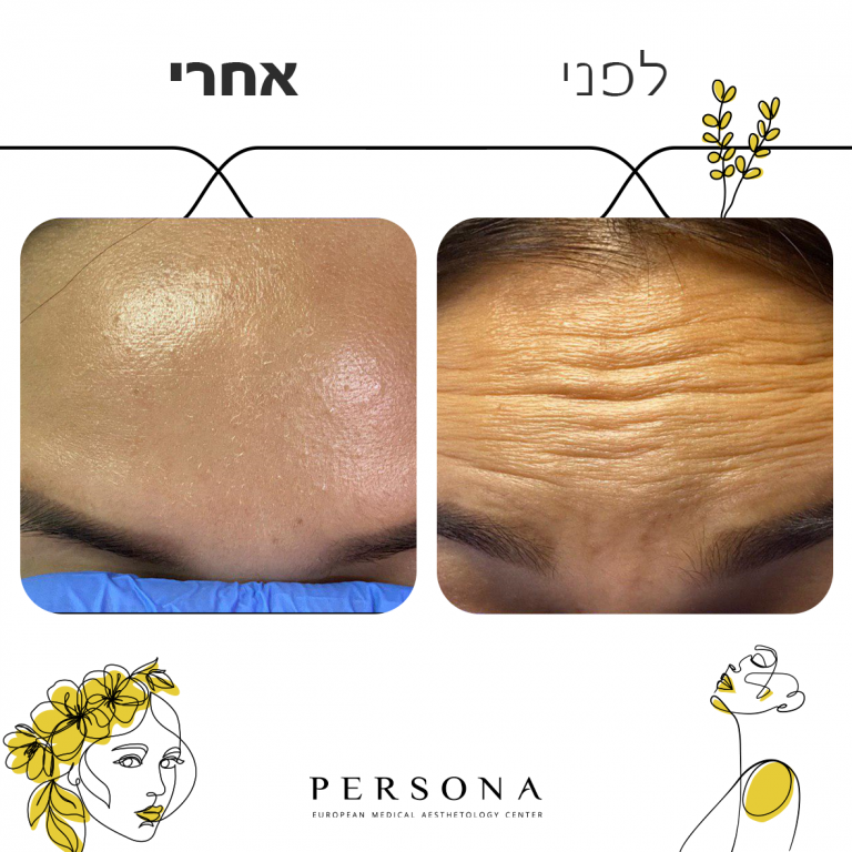 לפני אחרי קמטי הבעה1