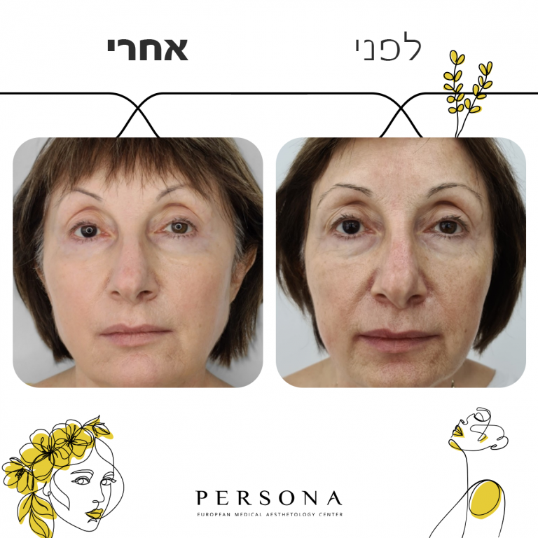 לפני אחרי קמטי הבעה2