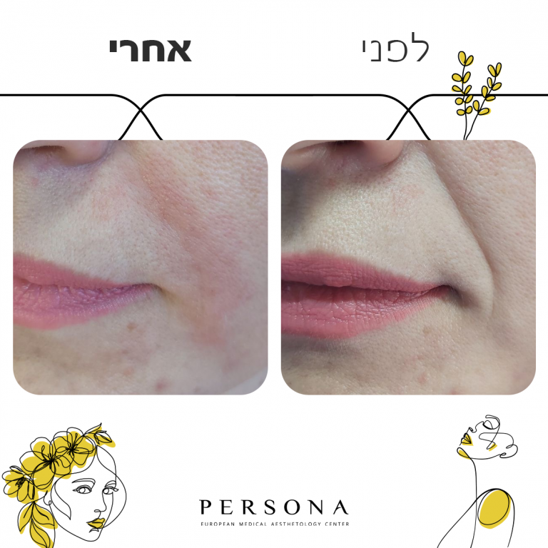 לפני אחרי קמטי הבעה3