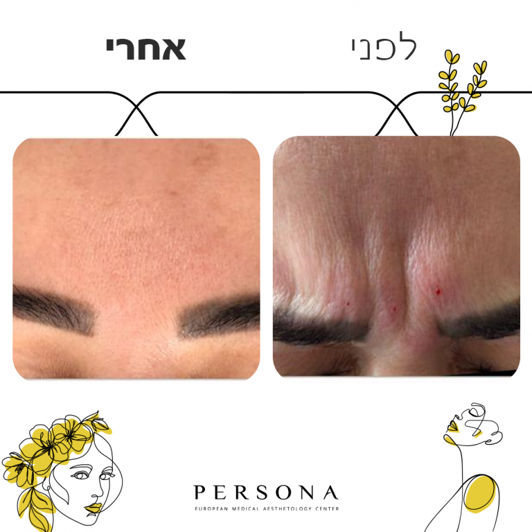 לפני אחרי קמטי הבעה4