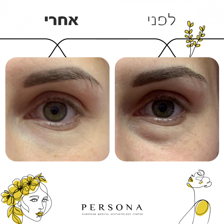 לפני אחרי שקעי עיניים 6