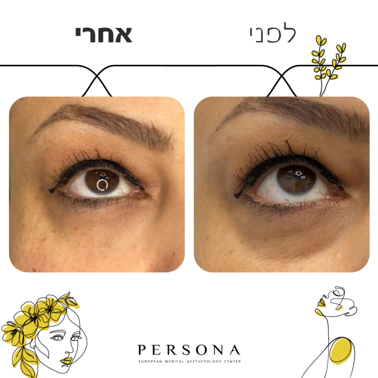 חדש לפני אחרי עיניים2