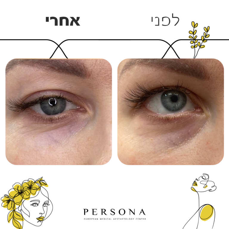 חדש לפני אחרי עיניים3