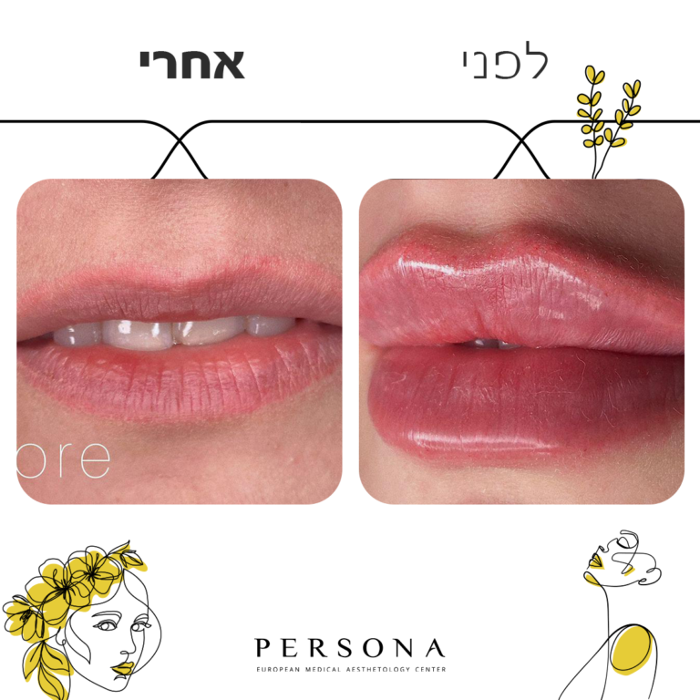 תבנית לפני אחרי FULL FACE3