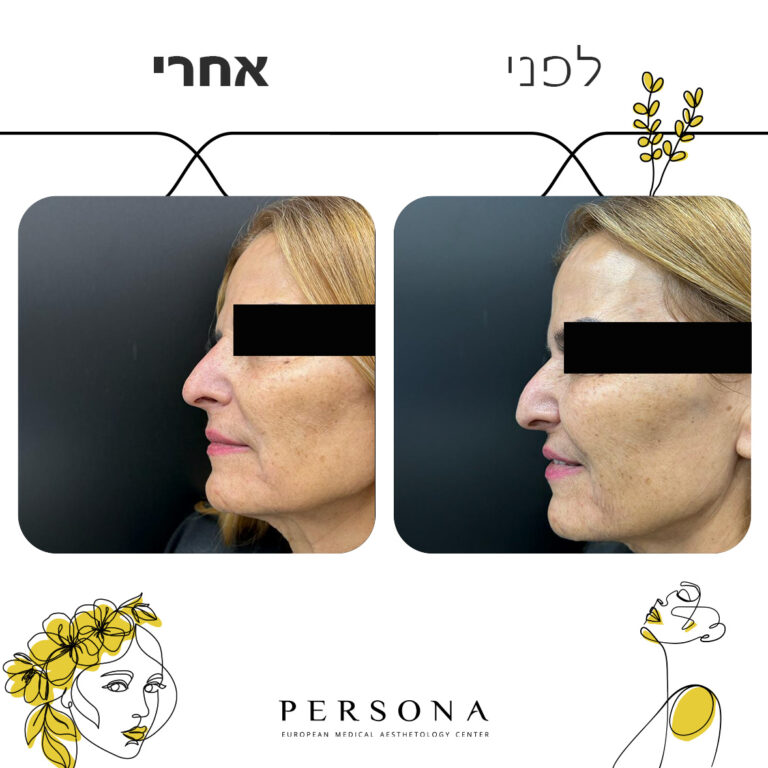 תבנית לפני אחרי12 copy