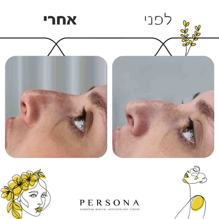 תבנית-לפני-אחרי2-copy_optimized