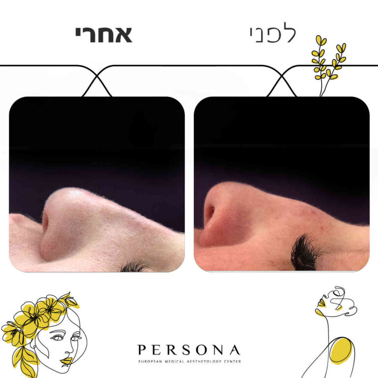 תבנית-לפני-אחרי5-copy_optimized