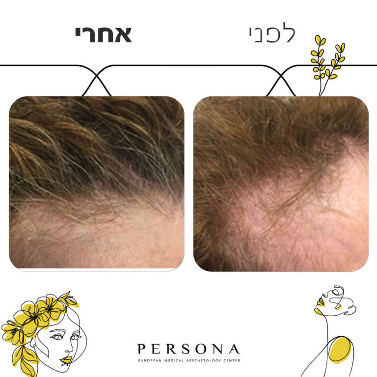 תבנית-לפני-אחרי7-copy_optimized