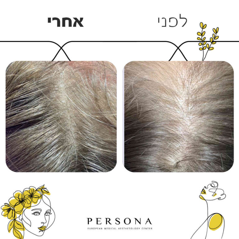 תבנית-לפני-אחרי8-copy_optimized