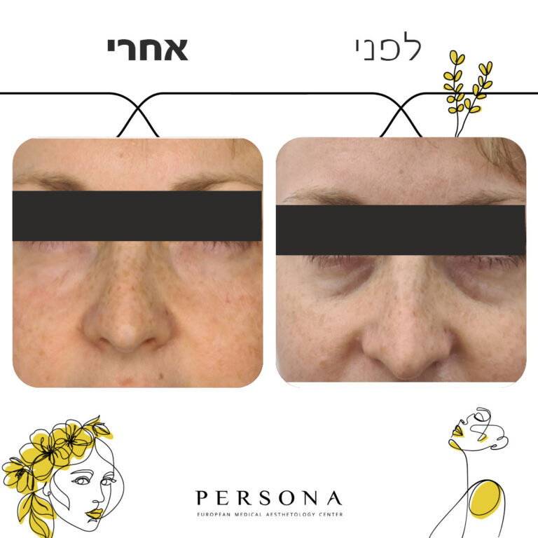 שקעי-עיניים-לפני-אחרי